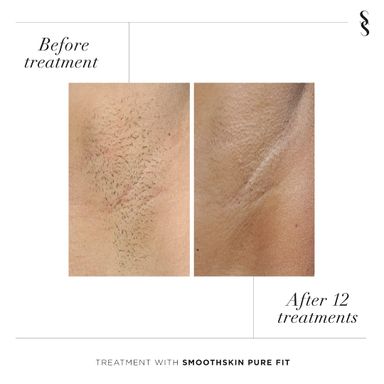 smoothskin-pure-fit-ipl